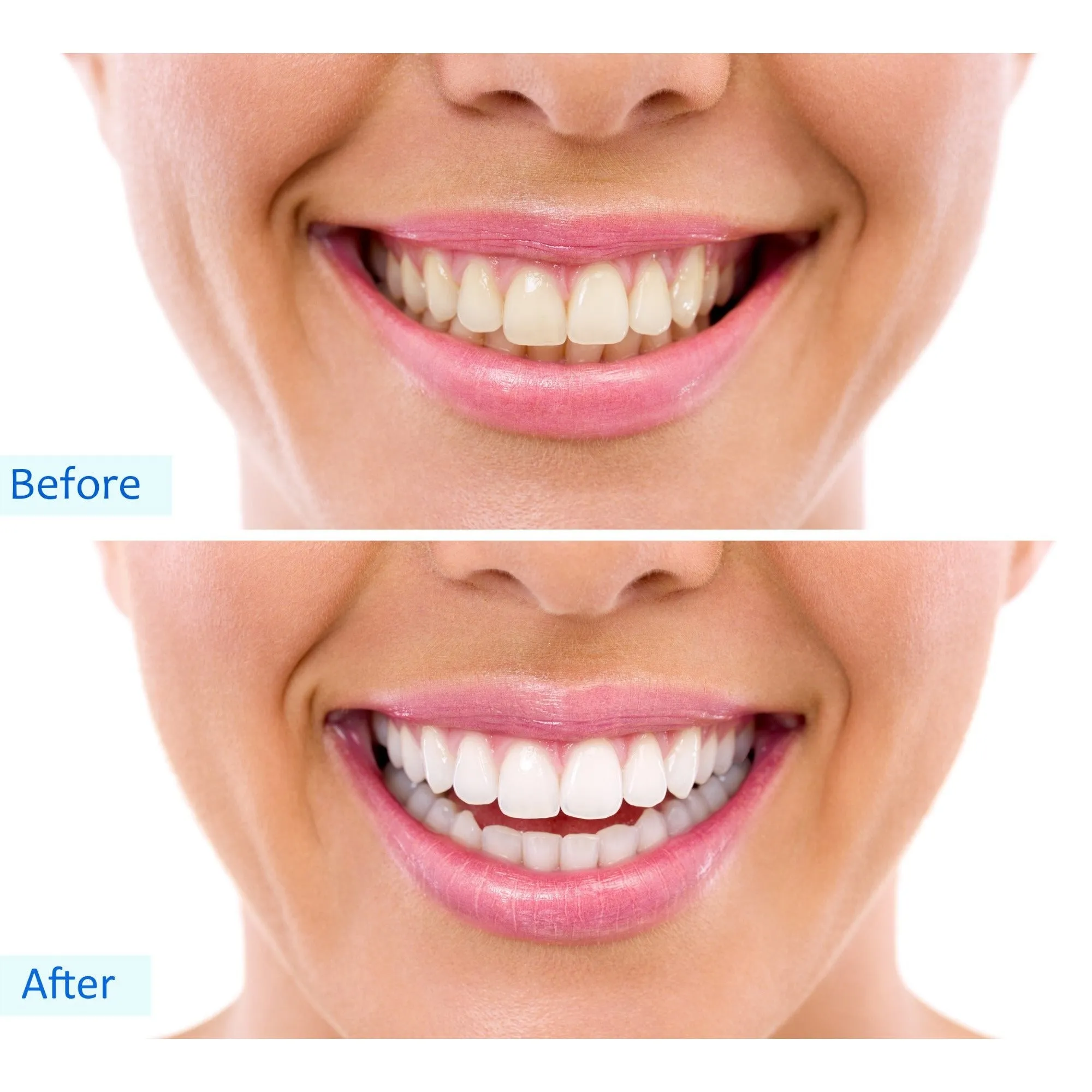 White in Minutes™ Home Teeth Whitening Kit